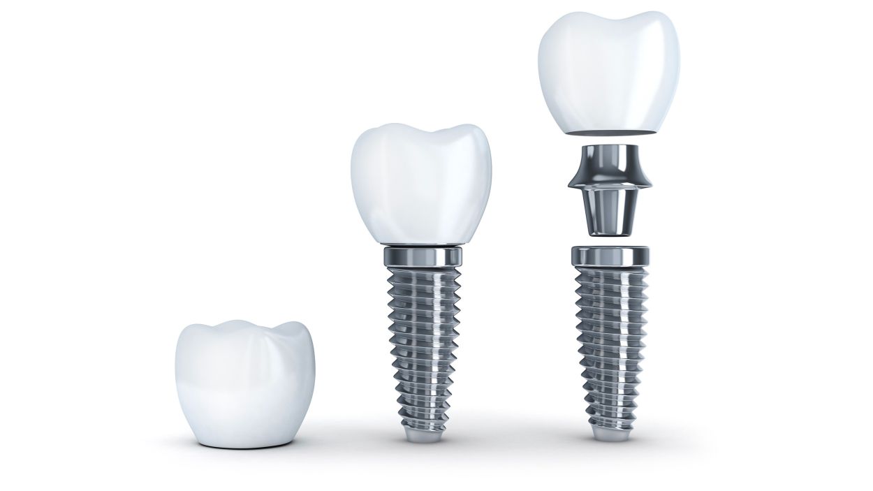 Dental Implants Open Event